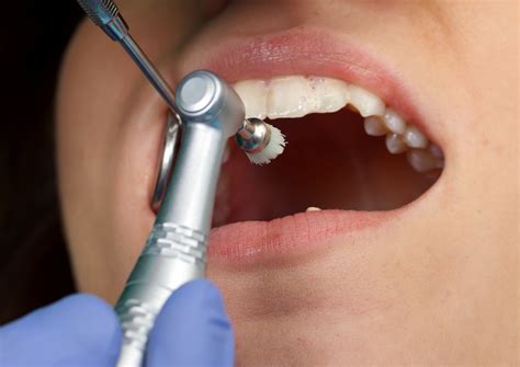 How Dental Bonding Can Improve the Appearance of Your Smile in Lewisville, TX